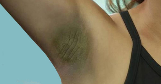 Koltuk Altı Lekeleri Belirtileri ve Tedavisi